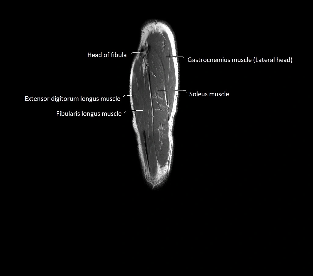 Lower leg sagittal anatomy 3T MRI image 5.webp